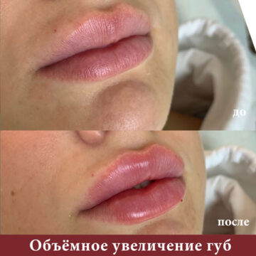 объемное увеличение губ до и после