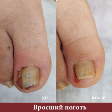 лечение вросшего ногтя в Смоленске
