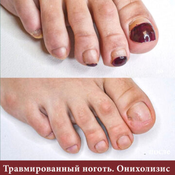 травма ногтя - лечение