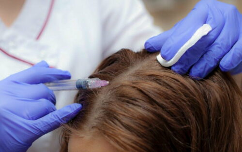 мезотерапия для волос в МКЦ Галатея